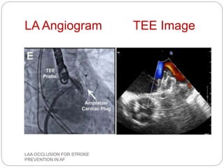 LA Angiogram TEE Image
LAA OCCLUSION FOR STROKE
PREVENTION IN AF
 