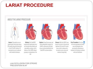 LARIAT PROCEDURE
LAA OCCLUSION FOR STROKE
PREVENTION IN AF
 
