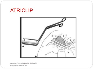 ATRICLIP
LAA OCCLUSION FOR STROKE
PREVENTION IN AF
 