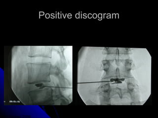Discogram Meaning Percutaneous lumbar nucleoplasty | PPT
