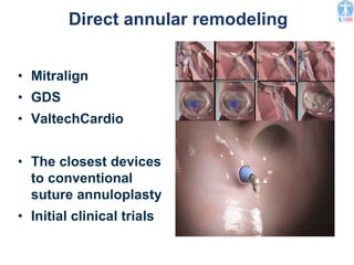 Direct annular remodeling
• Mitralign
• GDS
• ValtechCardio
• The closest devices
to conventional
suture annuloplasty
• Initial clinical trials
 