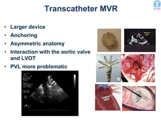 Transcatheter MVR
• Larger device
• Anchoring
• Asymmetric anatomy
• Interaction with the aortic valve
and LVOT
• PVL more problematic
 