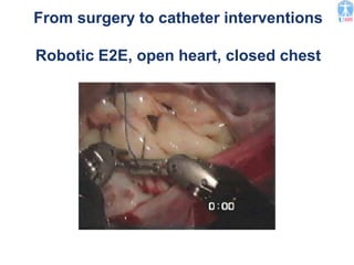 From surgery to catheter interventions
Robotic E2E, open heart, closed chest
 