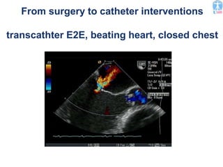 From surgery to catheter interventions
transcathter E2E, beating heart, closed chest
 
