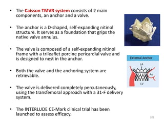 • The Caisson TMVR system consists of 2 main
components, an anchor and a valve.
• The anchor is a D-shaped, self-expanding nitinol
structure. It serves as a foundation that grips the
native valve annulus.
• The valve is composed of a self-expanding nitinol
frame with a trileaflet porcine pericardial valve and
is designed to nest in the anchor.
• Both the valve and the anchoring system are
retrievable.
• The valve is delivered completely percutaneously,
using the transfemoral approach with a 31-F delivery
system.
• The INTERLUDE CE-Mark clinical trial has been
launched to assess efficacy.
102
 