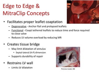 Edge to Edge &
MitraClip Concepts
• Facilitates proper leaflet coaptation
– Degenerative - Anchor flail and prolapsed leaflets
– Functional - Coapt tethered leaflets to reduce time and force required
to close valve
– Reduces LV volume overload by reducing MR
• Creates tissue bridge
– May limit dilatation of annulus
• Septal-lateral (A-P) dimension
– Supports durability of repair
• Restrains LV wall
– Limits LV dilatation Porcine model, 6M
 