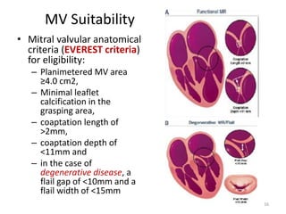 MV Suitability
• Mitral valvular anatomical
criteria (EVEREST criteria)
for eligibility:
– Planimetered MV area
≥4.0 cm2,
– Minimal leaflet
calcification in the
grasping area,
– coaptation length of
>2mm,
– coaptation depth of
<11mm and
– in the case of
degenerative disease, a
flail gap of <10mm and a
flail width of <15mm
16
 