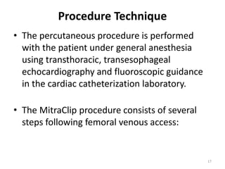 Procedure Technique
• The percutaneous procedure is performed
with the patient under general anesthesia
using transthoracic, transesophageal
echocardiography and fluoroscopic guidance
in the cardiac catheterization laboratory.
• The MitraClip procedure consists of several
steps following femoral venous access:
17
 