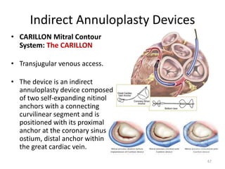 Indirect Annuloplasty Devices
• CARILLON Mitral Contour
System: The CARILLON
• Transjugular venous access.
• The device is an indirect
annuloplasty device composed
of two self-expanding nitinol
anchors with a connecting
curvilinear segment and is
positioned with its proximal
anchor at the coronary sinus
ostium, distal anchor within
the great cardiac vein.
67
 