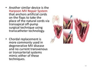 • Another similar device is the
Harpoon MV Repair System
that anchors artificial cords
on the flaps to take the
place of the natural cords via
transapical off-pump
surgical technique using
transcatheter technology.
• Chordal replacement is
more commonly used in
degenerative MV disease
and no current transvenous
or transarterial systems
mimic either of these
techniques.
94
 