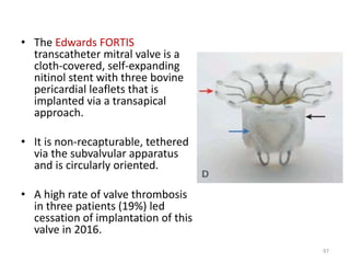 • The Edwards FORTIS
transcatheter mitral valve is a
cloth-covered, self-expanding
nitinol stent with three bovine
pericardial leaflets that is
implanted via a transapical
approach.
• It is non-recapturable, tethered
via the subvalvular apparatus
and is circularly oriented.
• A high rate of valve thrombosis
in three patients (19%) led
cessation of implantation of this
valve in 2016.
97
 