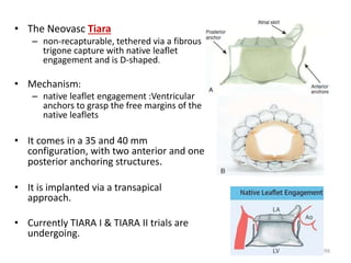 • The Neovasc Tiara
– non-recapturable, tethered via a fibrous
trigone capture with native leaflet
engagement and is D-shaped.
• Mechanism:
– native leaflet engagement :Ventricular
anchors to grasp the free margins of the
native leaflets
• It comes in a 35 and 40 mm
configuration, with two anterior and one
posterior anchoring structures.
• It is implanted via a transapical
approach.
• Currently TIARA I & TIARA II trials are
undergoing.
99
 