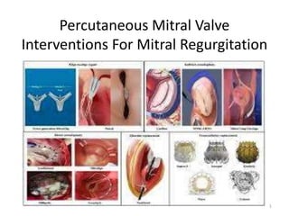 Percutaneous Mitral Valve
Interventions For Mitral Regurgitation
1
 