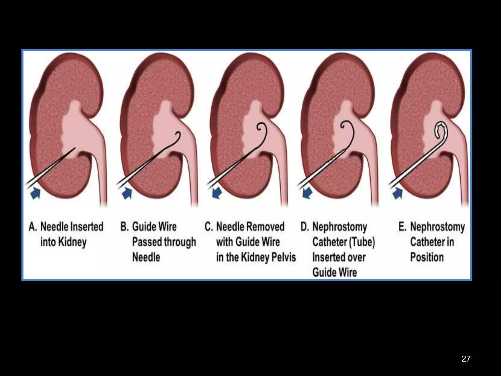 Percutaneous nephrostomy | PPTX
