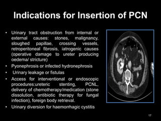 Indications for Insertion of PCN
• Urinary tract obstruction from internal or
external causes: stones, malignancy,
sloughed papillae, crossing vessels,
retroperitoneal fibrosis, iatrogenic causes
(operative damage to ureter producing
oedema/ stricture)
• Pyonephrosis or infected hydronephrosis
• Urinary leakage or fistulas
• Access for interventional or endoscopic
procedures:ureteric stenting, PCNL,
delivery of chemotherapy/medication (stone
dissolution, antibiotic therapy for fungal
infection), foreign body retrieval.
• Urinary diversion for haemorrhagic cystitis
17
 