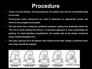 Procedure
• Prone or prone-oblique. During pregnancy, the patient may only be comfortable lying
on her side.
• Fluoroscopy and/or ultrasound are used to determine an appropriate access site
which is then prepped and draped.
• The skin entry site is along the ipsilateral posterior axillary line, preferably below the
11th rib to avoid entering the thorax. A subcostal approach is most comfortable for
patients. To avoid bleeding complications, the needle path to the kidney should be
along “Brodel bloodless line” .
• This path, typically 30 to 45 degrees with respect to the table. Ideally, a posterior lower
zone calyx should be targeted.
21
 