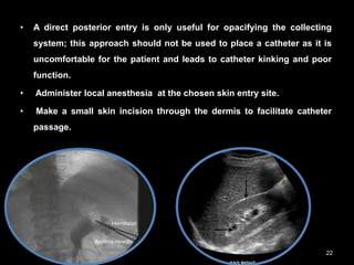 • A direct posterior entry is only useful for opacifying the collecting
system; this approach should not be used to place a catheter as it is
uncomfortable for the patient and leads to catheter kinking and poor
function.
• Administer local anesthesia at the chosen skin entry site.
• Make a small skin incision through the dermis to facilitate catheter
passage.
22
 