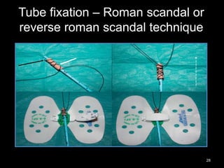 Tube fixation – Roman scandal or
reverse roman scandal technique
28
 