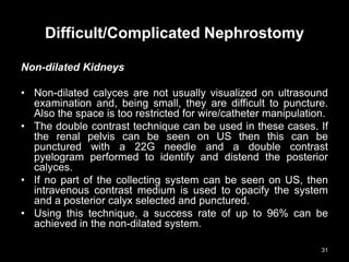 Difficult/Complicated Nephrostomy
Non-dilated Kidneys
• Non-dilated calyces are not usually visualized on ultrasound
examination and, being small, they are difficult to puncture.
Also the space is too restricted for wire/catheter manipulation.
• The double contrast technique can be used in these cases. If
the renal pelvis can be seen on US then this can be
punctured with a 22G needle and a double contrast
pyelogram performed to identify and distend the posterior
calyces.
• If no part of the collecting system can be seen on US, then
intravenous contrast medium is used to opacify the system
and a posterior calyx selected and punctured.
• Using this technique, a success rate of up to 96% can be
achieved in the non-dilated system.
31
 
