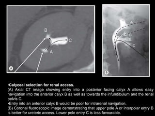 7
•Calyceal selection for renal access.
(A) Axial CT image showing entry into a posterior facing calyx A allows easy
navigation into the anterior calyx B as well as towards the infundibulum and the renal
pelvis C.
•Entry into an anterior calyx B would be poor for intrarenal navigation.
(B) Coronal fluoroscopic image demonstrating that upper pole A or interpolar entry B
is better for ureteric access. Lower pole entry C is less favourable.
 