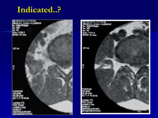 Pps Radiopaedia Percutaneous nucleoplasty | PPSX