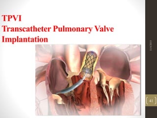 TPVI
Transcatheter Pulmonary Valve
Implantation
11/4/2015
41
 