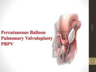 Percutaneous Balloon
Pulmonary Valvuloplasty
PBPV
11/4/2015
7
 