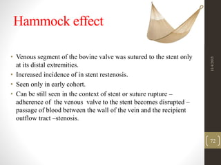 Hammock effect
• Venous segment of the bovine valve was sutured to the stent only
at its distal extremities.
• Increased incidence of in stent restenosis.
• Seen only in early cohort.
• Can be still seen in the context of stent or suture rupture –
adherence of the venous valve to the stent becomes disrupted –
passage of blood between the wall of the vein and the recipient
outflow tract –stenosis.
11/4/2015
72
 
