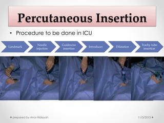 percutaneous tracheostomy procedure