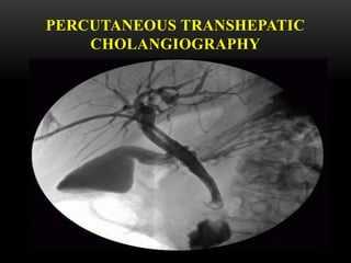 Percutaneous Transhepatic Cholangiography
