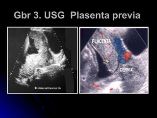 Gbr 3. USG Plasenta previaGbr 3. USG Plasenta previa
 