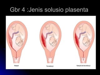 Gbr 4 :Jenis solusio plasentaGbr 4 :Jenis solusio plasenta
 
