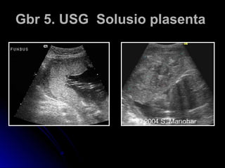 Gbr 5. USG Solusio plasentaGbr 5. USG Solusio plasenta
 