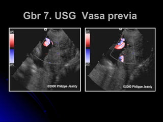 Gbr 7. USG Vasa previaGbr 7. USG Vasa previa
 