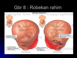 Gbr 8 : Robekan rahimGbr 8 : Robekan rahim
 
