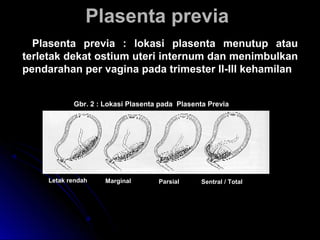 Plasenta previaPlasenta previa
Plasenta previa : lokasi plasenta menutup atauPlasenta previa : lokasi plasenta menutup atau
terletak dekat ostium uteri internum dan menimbulkanterletak dekat ostium uteri internum dan menimbulkan
pendarahan per vagina pada trimester II-III kehamilanpendarahan per vagina pada trimester II-III kehamilan
Gbr. 2 : Lokasi Plasenta pada Plasenta PreviaGbr. 2 : Lokasi Plasenta pada Plasenta Previa
Letak rendahLetak rendah MarginalMarginal ParsialParsial Sentral / TotalSentral / Total
 