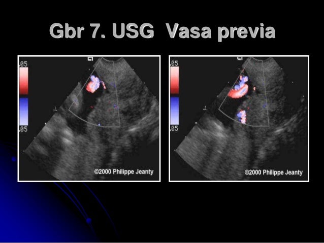 Perdarahan ante partum PARAMATA RAHA