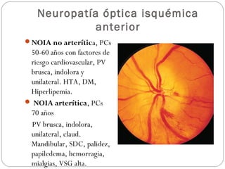Neuropatía óptica isquémica
anterior
NOIA no arterítica, PCs
50-60 años con factores de
riesgo cardiovascular, PV
brusca, indolora y
unilateral. HTA, DM,
Hiperlipemia.
 NOIA arterítica, PCs
70 años
PV brusca, indolora,
unilateral, claud.
Mandibular, SDC, palidez,
papiledema, hemorragia,
mialgias, VSG alta.
 