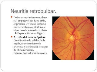 Neuritis retrobulbar.
Dolor en movimientos oculares
y al empujar el ojo hacia atrás,
se produce PV tras el ejercicio
físico, escotoma central, no se
observa nada anómalo en el ojo
(Exploración neurológica).
Atrofia del nervio óptico:
Combinación de palidez de la
papila, estrechamiento de
arteriolas y destrucción de capas
de fibras nerviosas.
Enfermedades desmielinizantes.
 