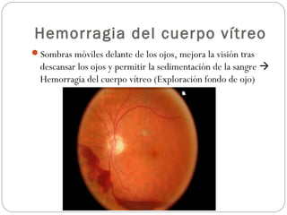 Hemorragia del cuerpo vítreo
Sombras móviles delante de los ojos, mejora la visión tras
descansar los ojos y permitir la sedimentación de la sangre 
Hemorragia del cuerpo vítreo (Exploración fondo de ojo)
 