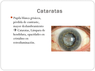 Cataratas
Pupila blanca grisácea,
pérdida de contraste,
mayor deslumbramiento
 Cataratas, Lámpara de
hendidura, opacidades en
cristalino en
retroiluminación.
 