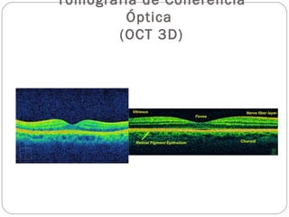 Tomografía de Coherencia
Óptica
(OCT 3D)
 