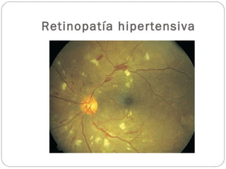 Retinopatía hipertensiva
 