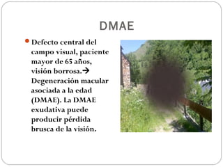DMAE
Defecto central del
campo visual, paciente
mayor de 65 años,
visión borrosa.
Degeneración macular
asociada a la edad
(DMAE). La DMAE
exudativa puede
producir pérdida
brusca de la visión.
 