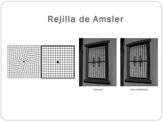 Rejilla de Amsler
 