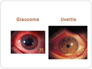 Glaucoma Uveitis
 