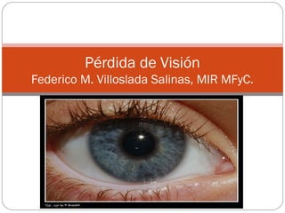 Pérdida de Visión
Federico M. Villoslada Salinas, MIR MFyC.
 