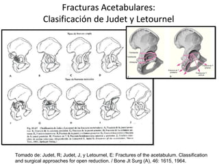 Judet Letournel Classification Perez Garcia. Nuestra experiencia en las fracturas periacetabulares con ...