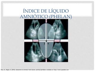 ÍNDICE DE LÍQUIDO
AMNIÓTICO (PHELAN)
Ross, M., Megan, E. (2018). Assessment of amniotic fluid volume. [online] UpToDate. A...