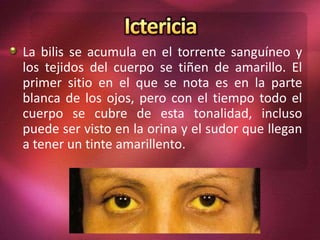 La bilis se acumula en el torrente sanguíneo y
los tejidos del cuerpo se tiñen de amarillo. El
primer sitio en el que se nota es en la parte
blanca de los ojos, pero con el tiempo todo el
cuerpo se cubre de esta tonalidad, incluso
puede ser visto en la orina y el sudor que llegan
a tener un tinte amarillento.
 